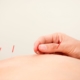 Acupuncture, Chinese Medicine,