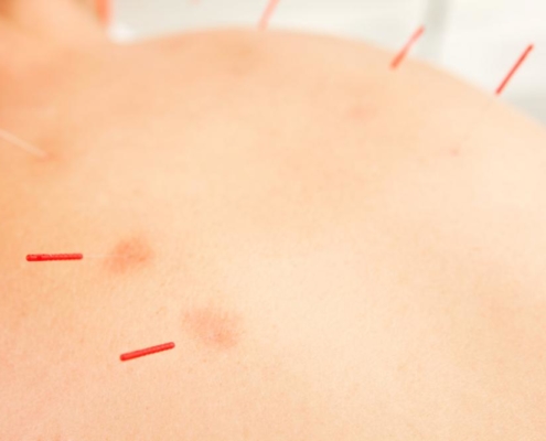 acupuncture, benefits