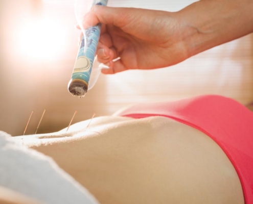 Acupuncture, weight loss, health, benefits, energy