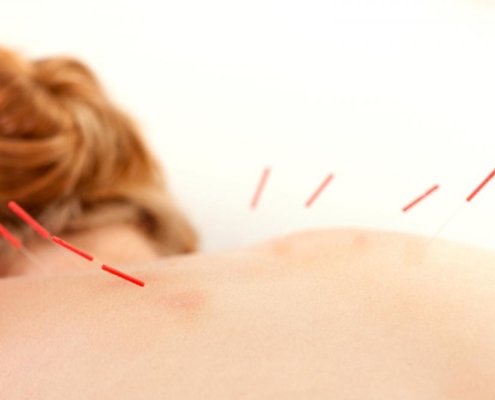 acupuncture, needles, benefits
