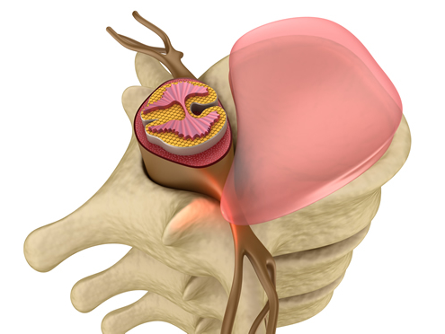 bulging disc chiropractic benefits
