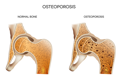 osteoporosis chiropractic benefits