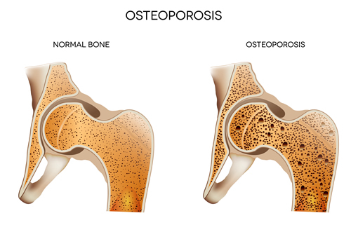 osteoporosis chiropractic benefits