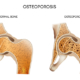 osteoporosis chiropractic benefits