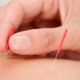 nerve acupuncture