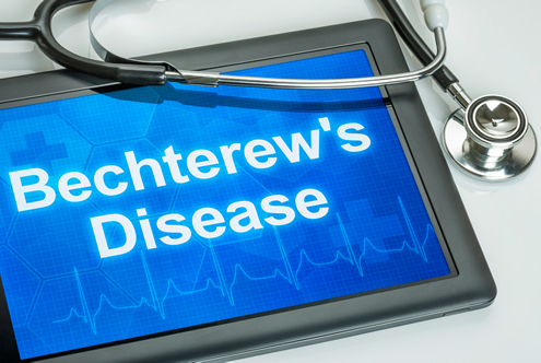 Ankylosing Spondylitis chiropractic benefits