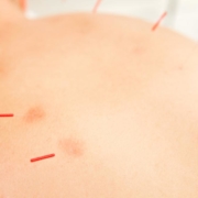 Acupuncture Benefits Edmonton