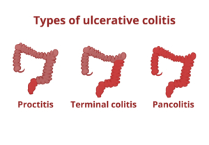Ulcerative Colitis, Chiropractic