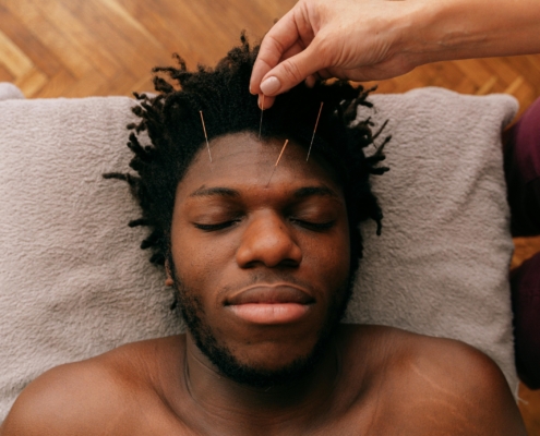 Facial Acupuncture