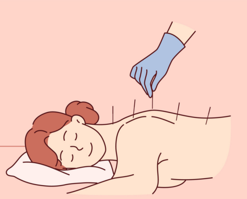 a calm, bright treatment room with a qualified practitioner placing acupuncture needles; search “professional acupuncture treatment wellness clinic