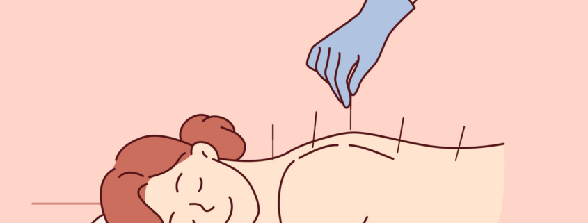 a calm, bright treatment room with a qualified practitioner placing acupuncture needles; search “professional acupuncture treatment wellness clinic