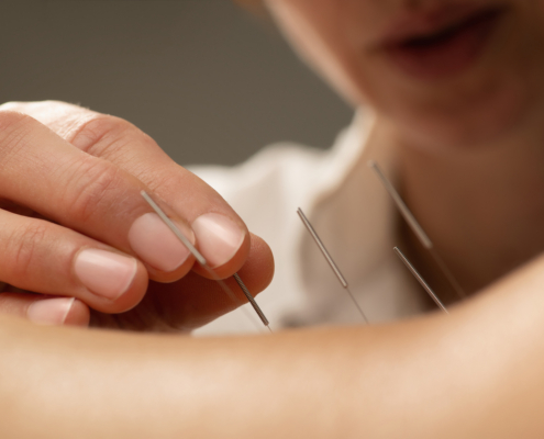 acupuncture for nerve damage