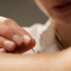 acupuncture for nerve damage
