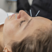 acupuncture for anxiety in Edmonton