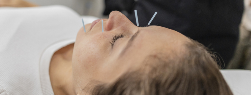 acupuncture for anxiety in Edmonton